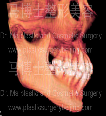 角度大的下颌角