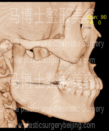 角度小的下颌角