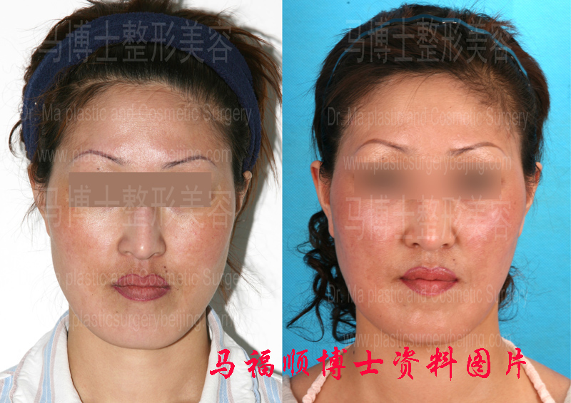 反颌整形术前及术后