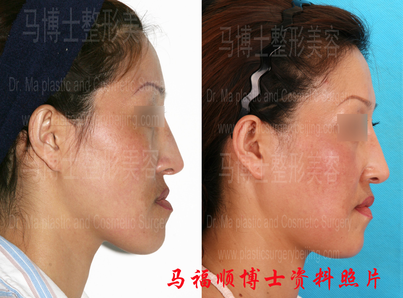 反颌整形对比照片