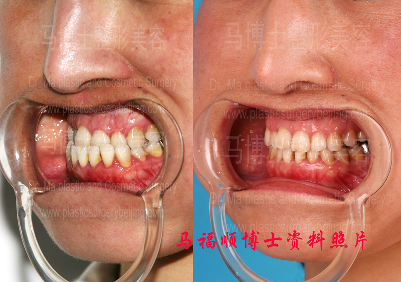 兜齿整形对比照片