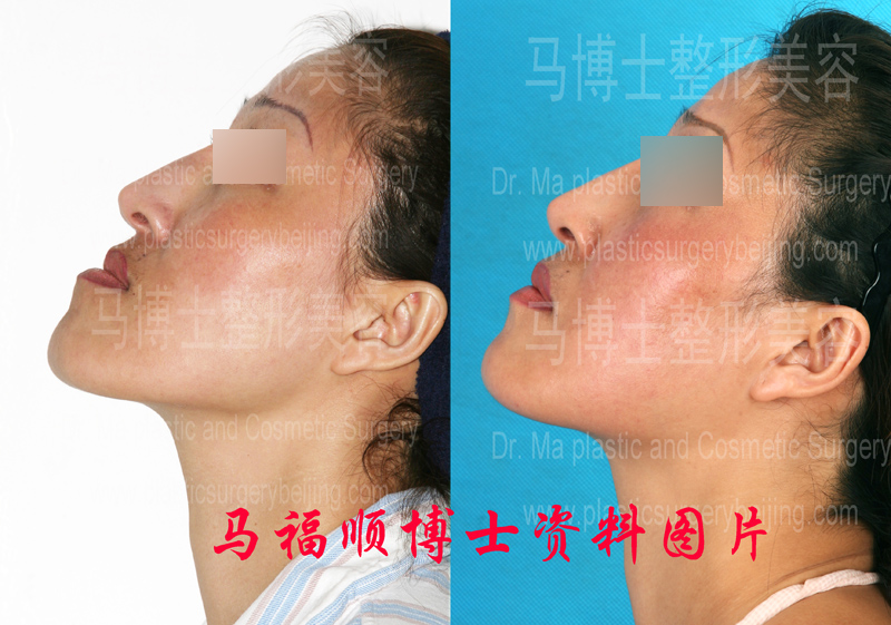 反颌整形仰头位对比照片