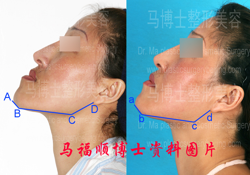 反颌整形仰头位对比照片分析