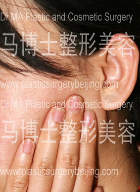 咬肌肥大自我检查方法