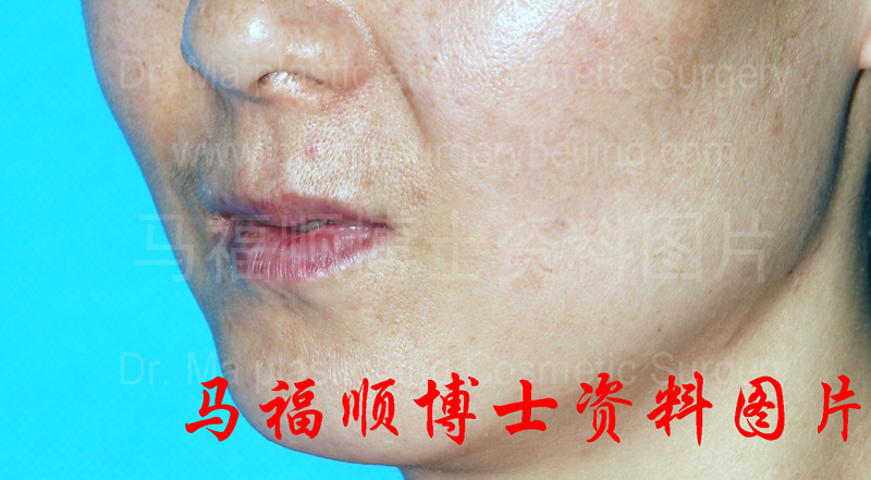 上下颌前突整形术后上唇变薄斜位