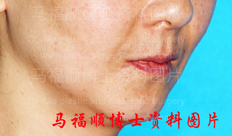 上下颌前突整形术后上唇变薄斜位