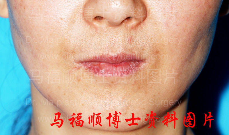 上下颌前突整形术后上唇变薄正面