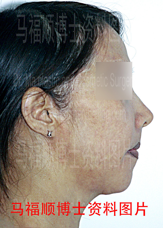 上下颌前突整形术后上唇变薄侧面