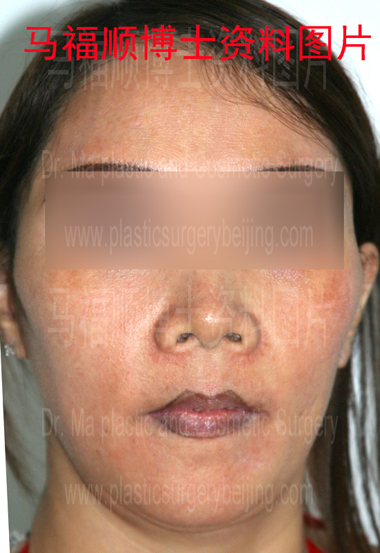 上下颌前突整形术后上唇变薄正面