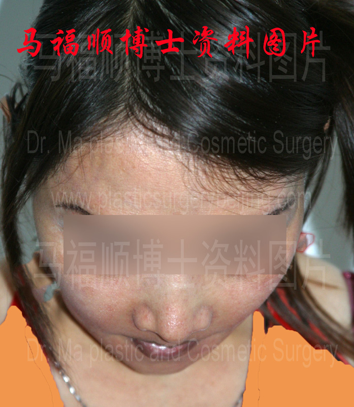 上下颌前突整形术后上唇变薄低头位