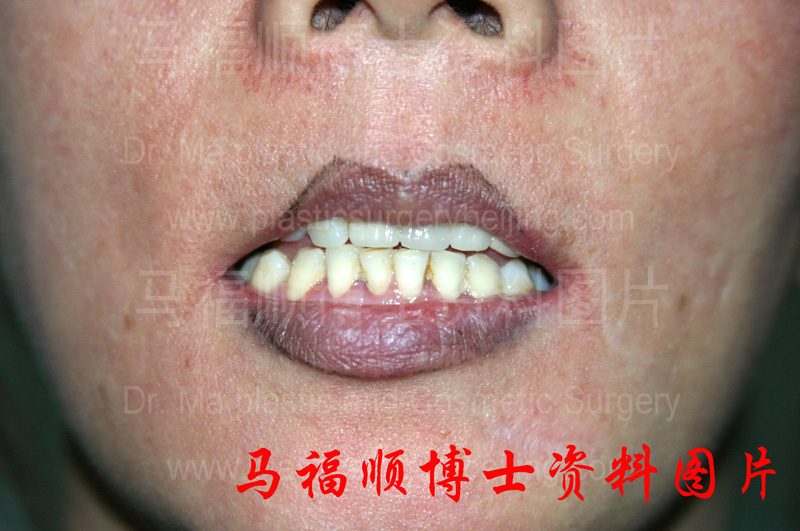 上下颌前突整形术后上唇变薄正面
