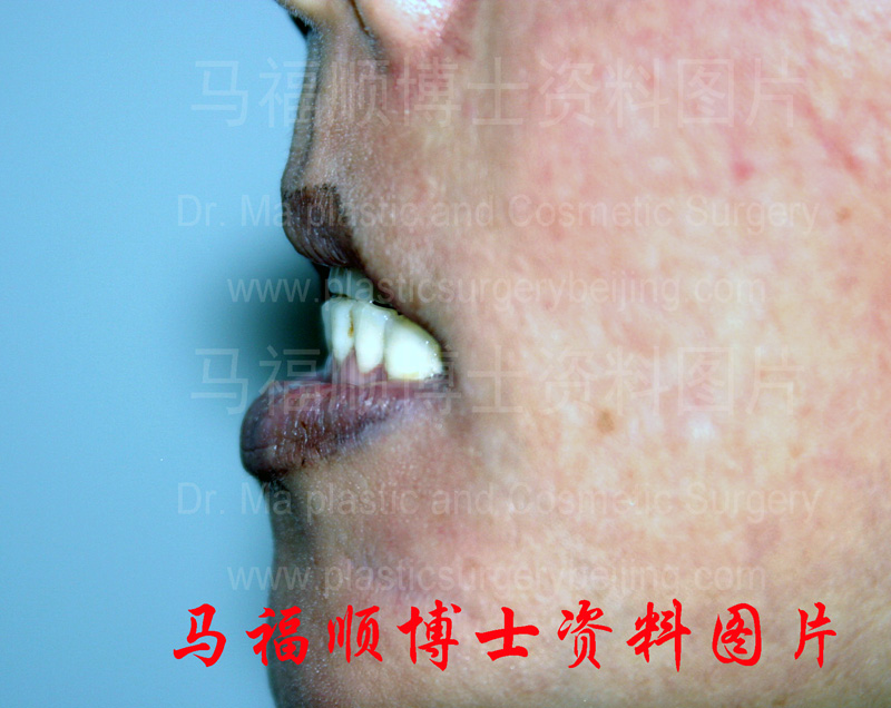 上下颌前突整形术后上唇变薄侧面