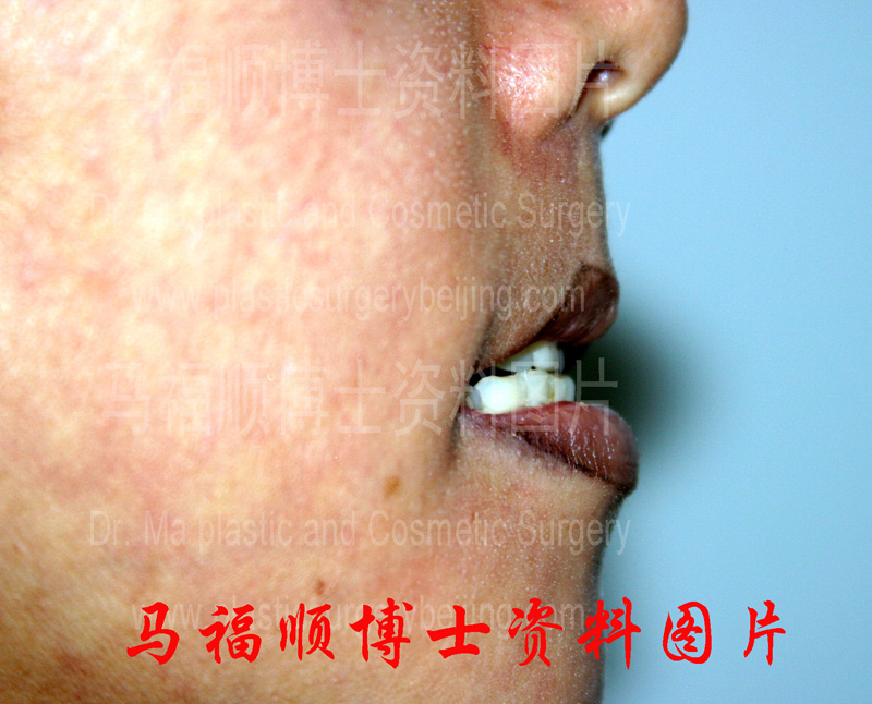 上下颌前突整形术后上唇变薄侧面