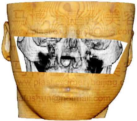 颧骨颧弓在面部投影正面