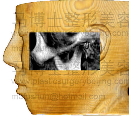 颧骨颧弓在面部投影侧面