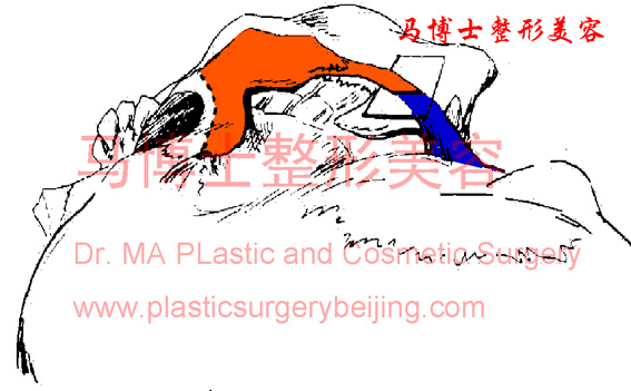 颧骨颧弓整形术式