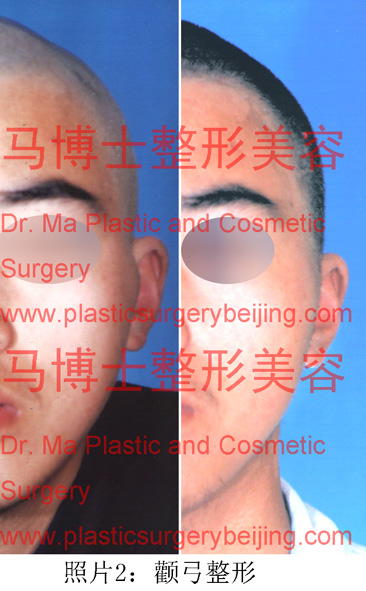 颧骨颧弓整形手术前后对比