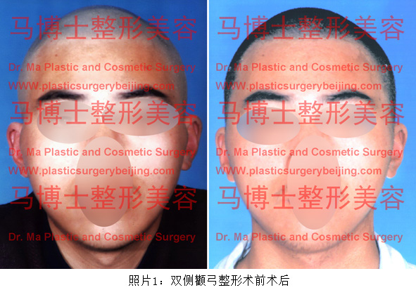 颧骨颧弓整形手术前后对比