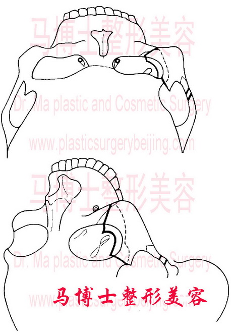 三角架式颧骨颧弓缩小整形术