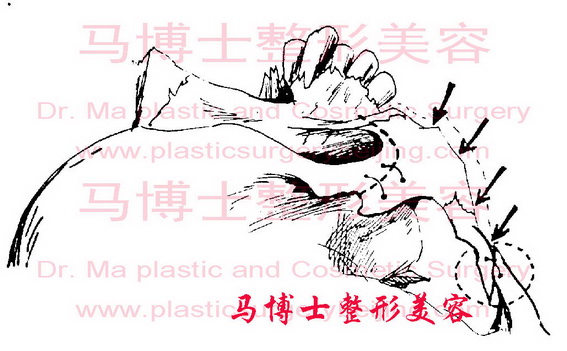 颧弓后端截骨法颧骨颧弓整形术后固定