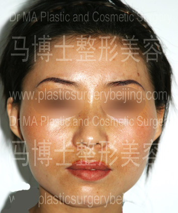 颧骨颧弓突出者正面照片