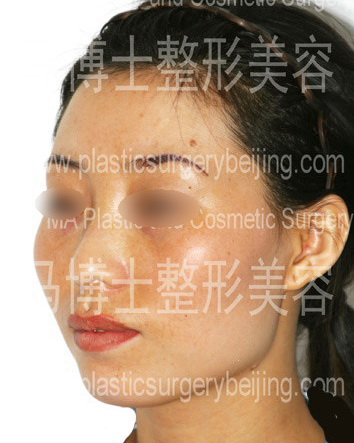 颧骨颧弓突出者45度角照片