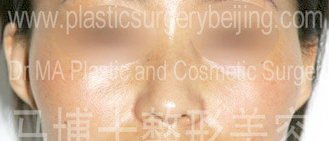 颧骨颧弓整形适应证