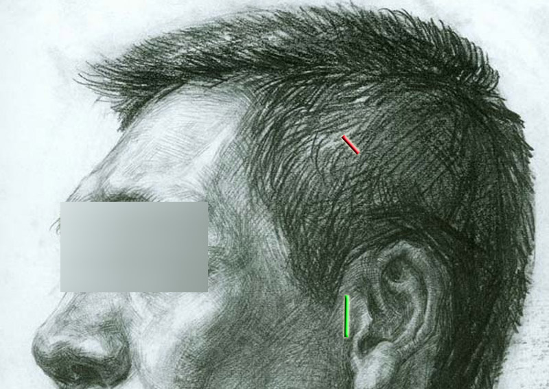 颧骨颧弓舒平术发际内切口位置