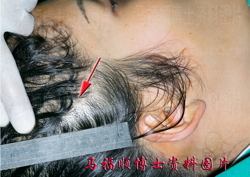 颧骨颧弓舒平术外切口愈合后