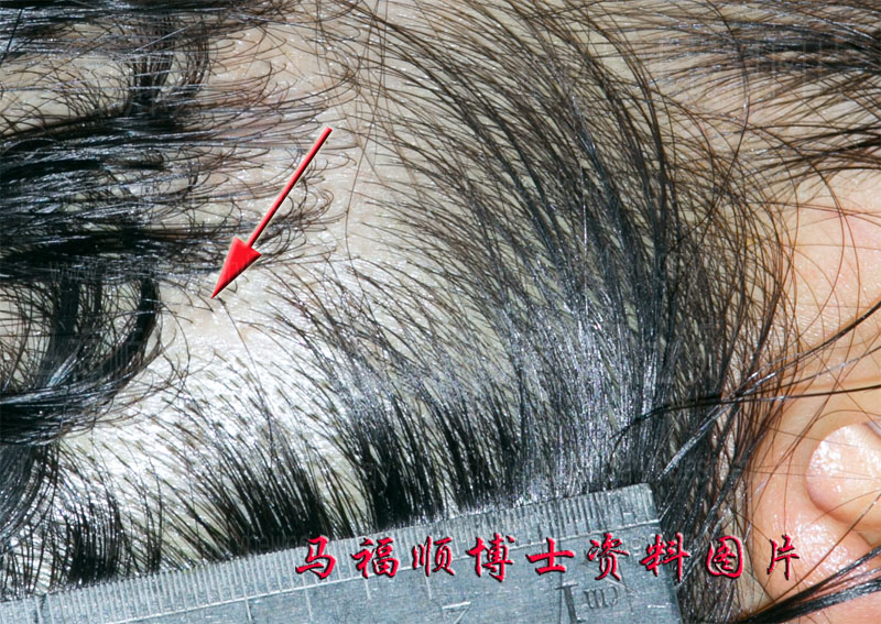 颧骨颧弓舒平术外科口愈合后