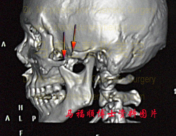 左侧颧骨颧弓缺损