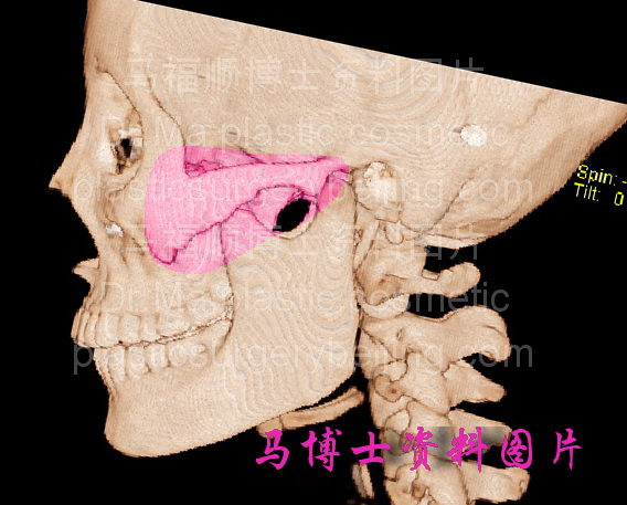 正常左侧颧弓颧骨