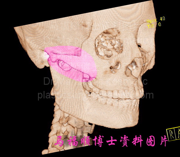 正常颧骨颧弓结构