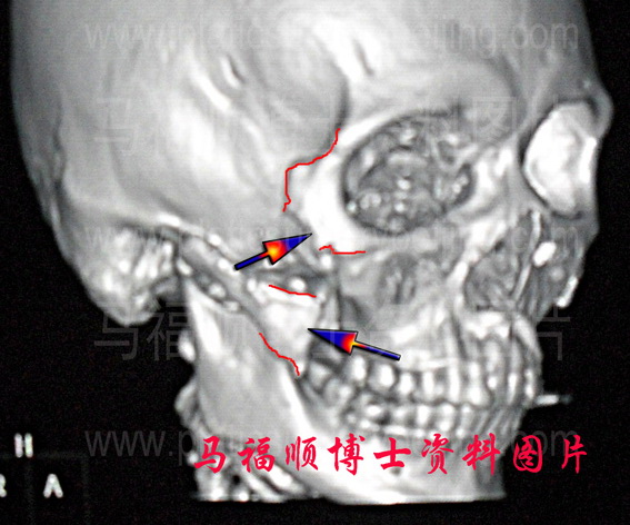 颧骨颧弓内推后下垂