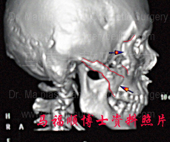 右侧颧骨颧弓下垂