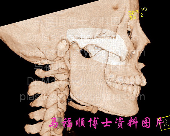 正常人颧骨颧弓结构
