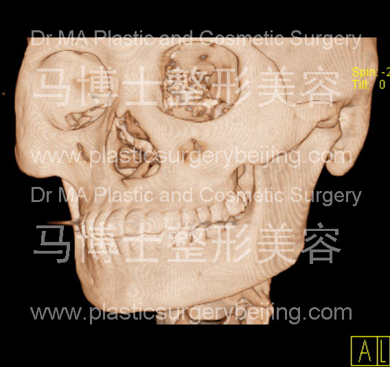 宽脸型者的颌面骨形状45度角