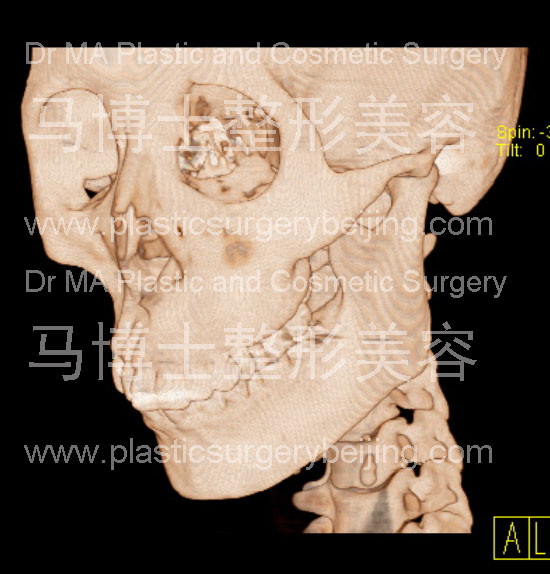 脸型瘦小者的颌面骨骼形状45度角