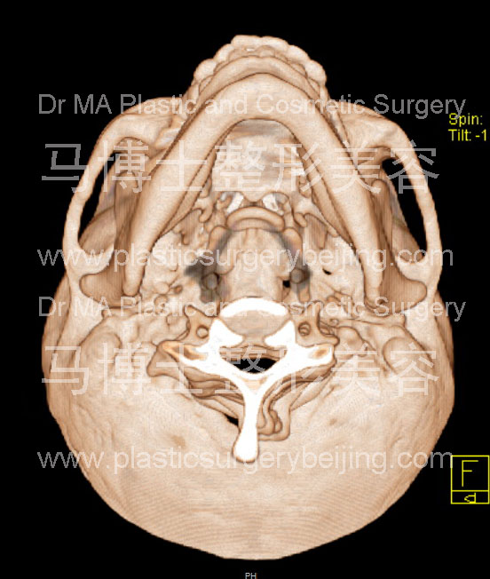 脸型瘦小者的颌面骨骼形状仰头位