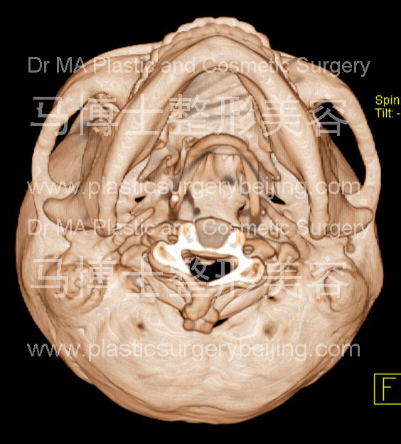 宽脸型者的颌面骨形状仰头位
