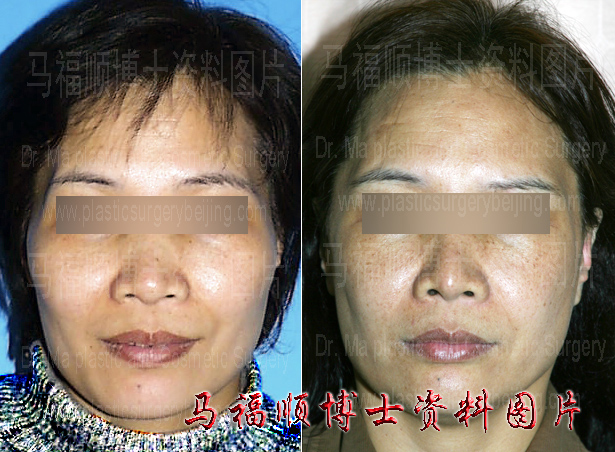 颧骨颧弓内推整形术后5年