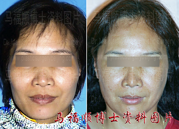 颧骨颧弓内推整形术后7年