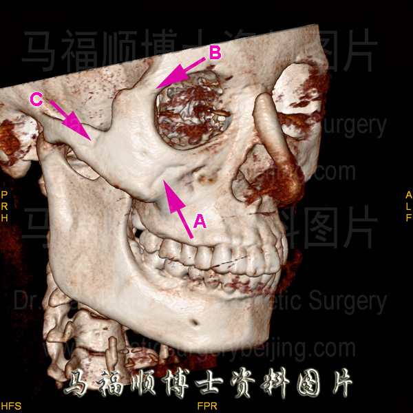 颌面骨的CT三维成像图片