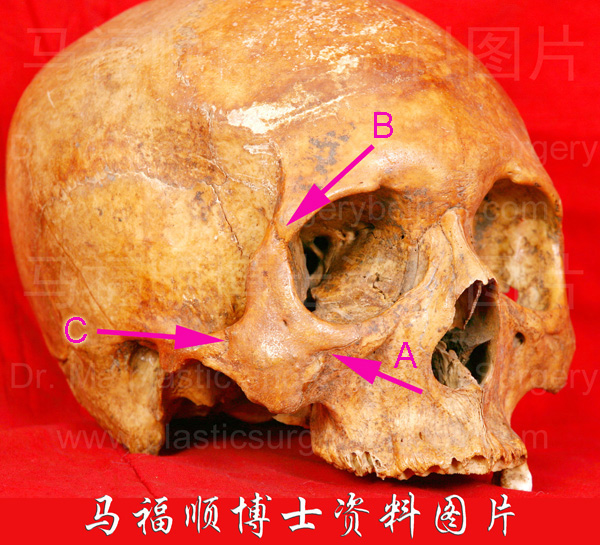 颧骨在颅骨上的位置