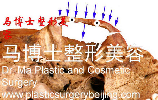 颧骨颧弓舒平术