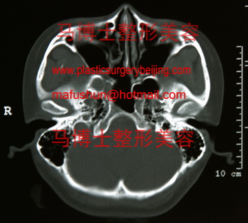 宽形脸颧骨颧弓截面