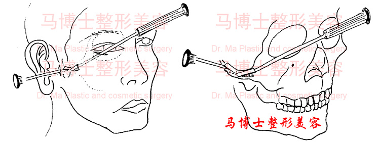 颧骨颧弓骨质去除术