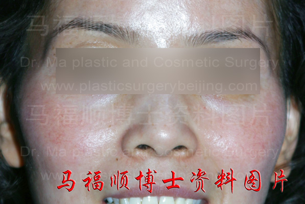 高颧骨高颧弓照片