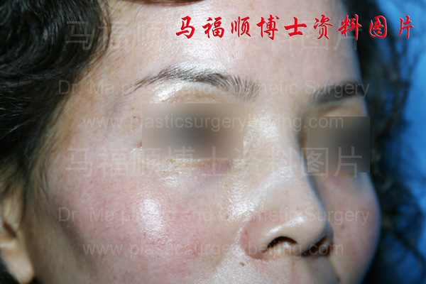 高颧骨高颧弓照片