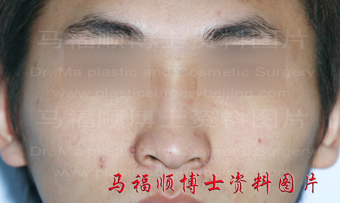 高颧弓颧骨照片